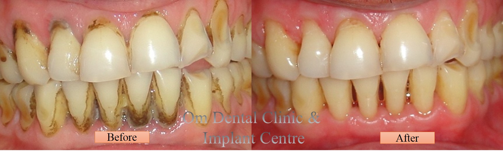Regular cleaning polishing makes teeth and gums healthy and strengthens them...