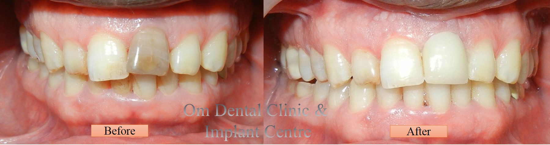 Zirconia Crown to correct position, color  & look of the Smile