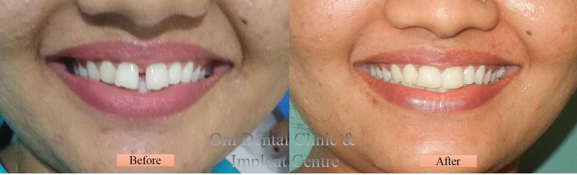 Fix your gaps in an hour with composite fillings