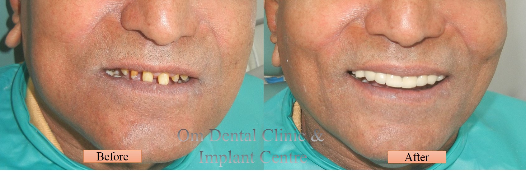 Chewing perfectly, Smiling & Speaking confidently with Dental Implants..