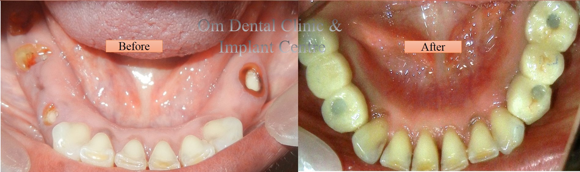 Efficient chewing reestablished with Dental Implants