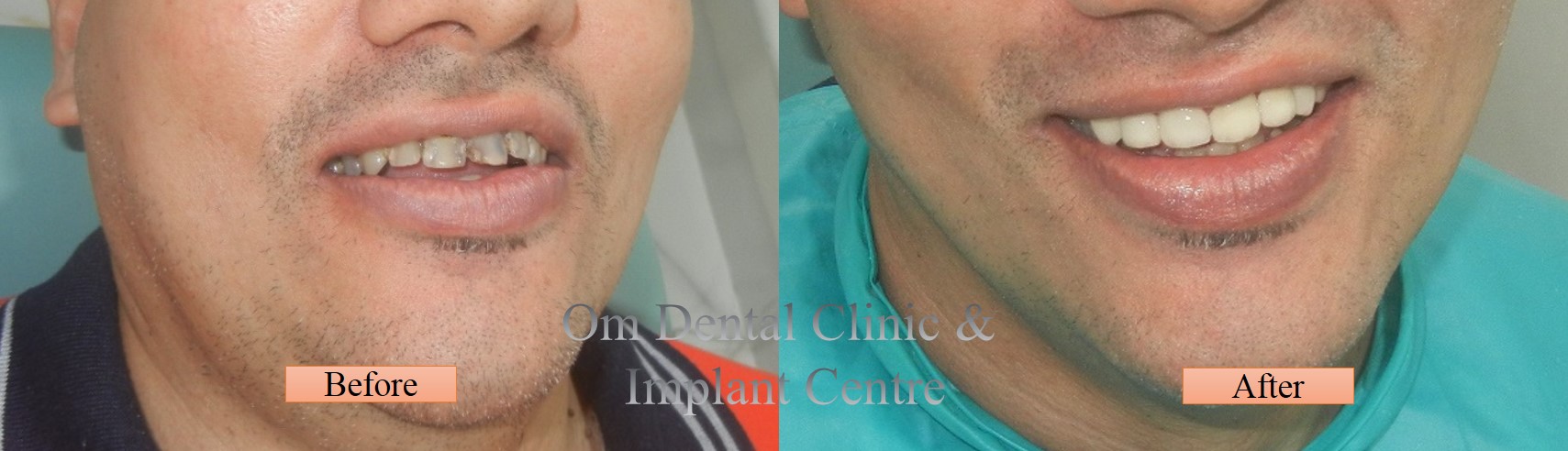 Zirconia Crowns giving life to the SMILE..